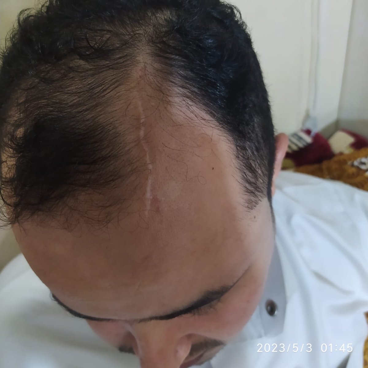 الحووثي عبدالقادر المرتضى.
كان يقوم بالإعتداء على المختطفين وتعذيبهم.
تشاهدون في الصورة أثر التعذيب والإعتداء الذي تعرض له الصحفي توفيق المنصوري في معتقلات الحووثي من قبل المدعو المرتضى.
يجب إجراء تحقيق بشأن ذلك ومحاكمة الجناة واتخاذ الإجراءات بشأنهم محلياً ودولياً.
#الحوثي_فارسي