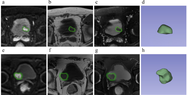Systematic radiomics analysis based on multiparameter MRI to preoperatively predict the expression of Ki67 and histological grade in patients with bladder cancer
bit.ly/3HDbipx
#Radiology #RadOnc