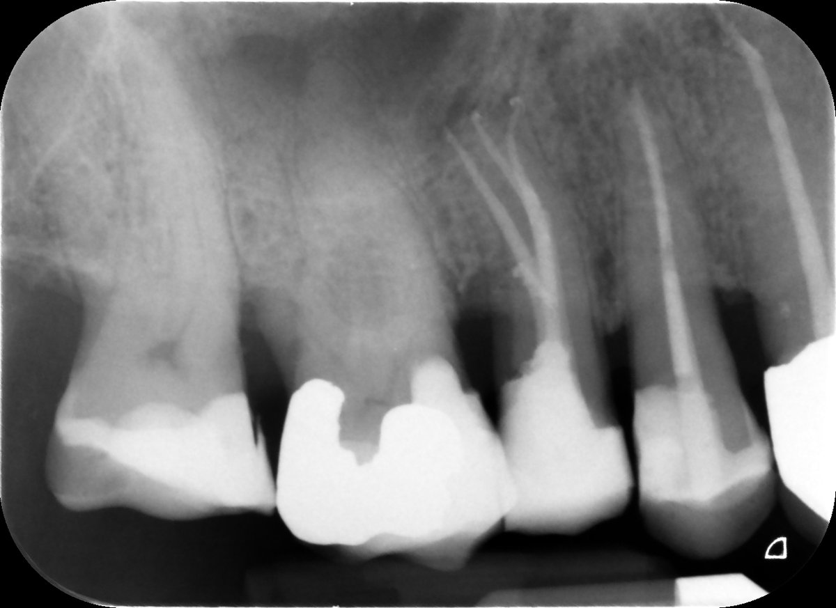 Here in Endo-land its a three-rooted UR5...CBCT was invaluable in diagnosis and assessment of the challenge ahead! Wave.One Gold preps <a href="/DENTSPLY_UK/">Dentsply Sirona UK</a> <a href="/DentsplySirona/">Dentsply Sirona</a> 
🤣