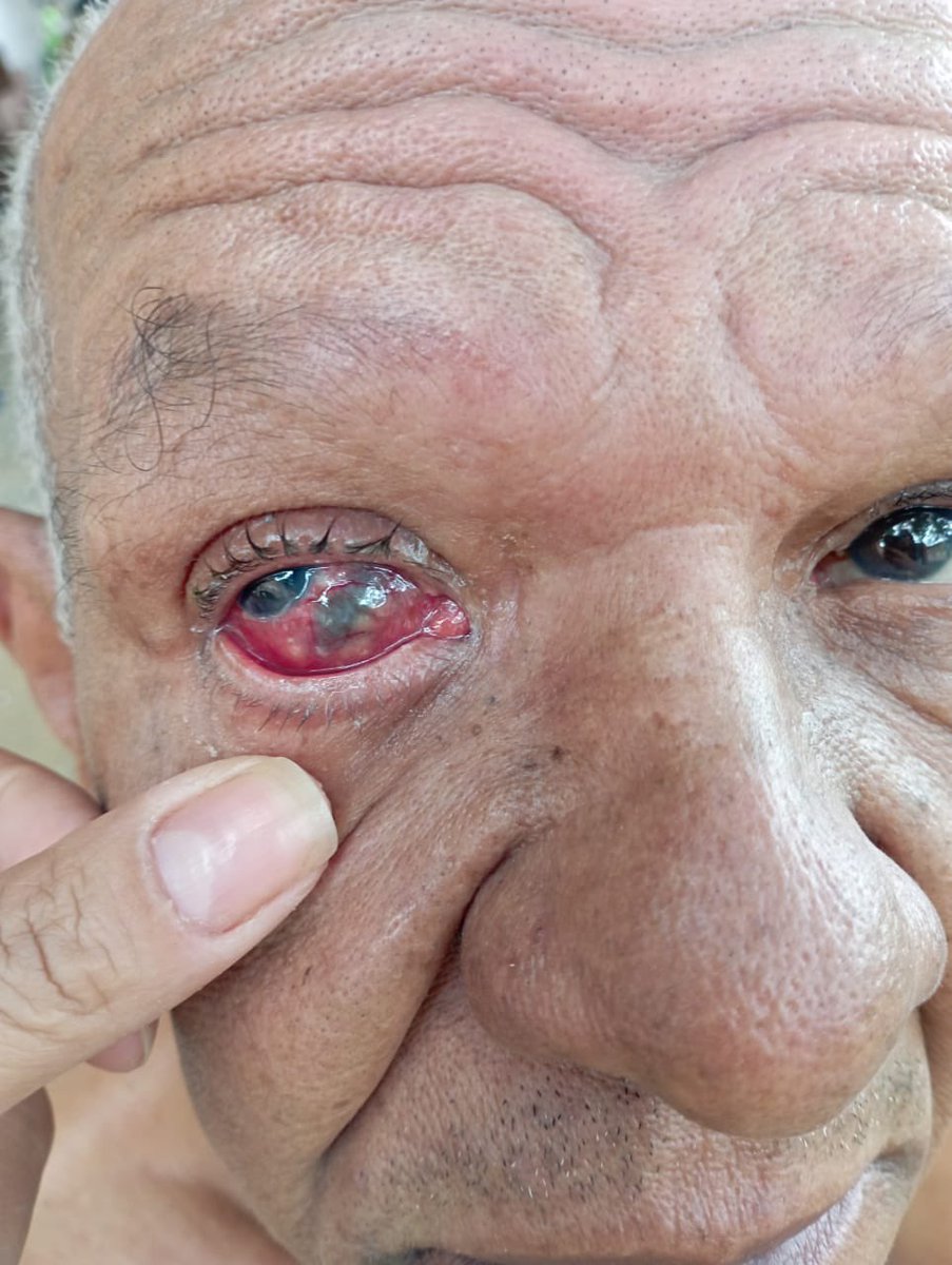 DuDudEddu's tweet photo. INDIGNADO!
Meu pai sofreu um acidente desde dezembro de 2022 onde roupeiro a terceira camada do globo ocular e até então está vindo tentando operar no hospital geral de Bonsucesso e sem sucesso…
Continua nos comentários ➡️
#RJTv #hospitalbonsucesso #globo #descaso https://t.co/cxqEOehvvS