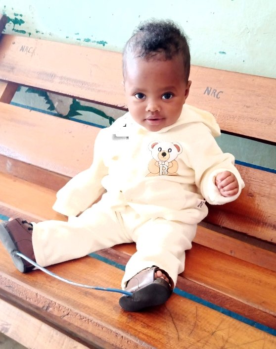 Baby K was brought to NRCC at only 2 months old with severe club foot. Her young mother was very distressed but she is now happy because her baby's feet are now in the desired position and she won't be laughed at.👇pics of her before and after..still on treatment. 🙏