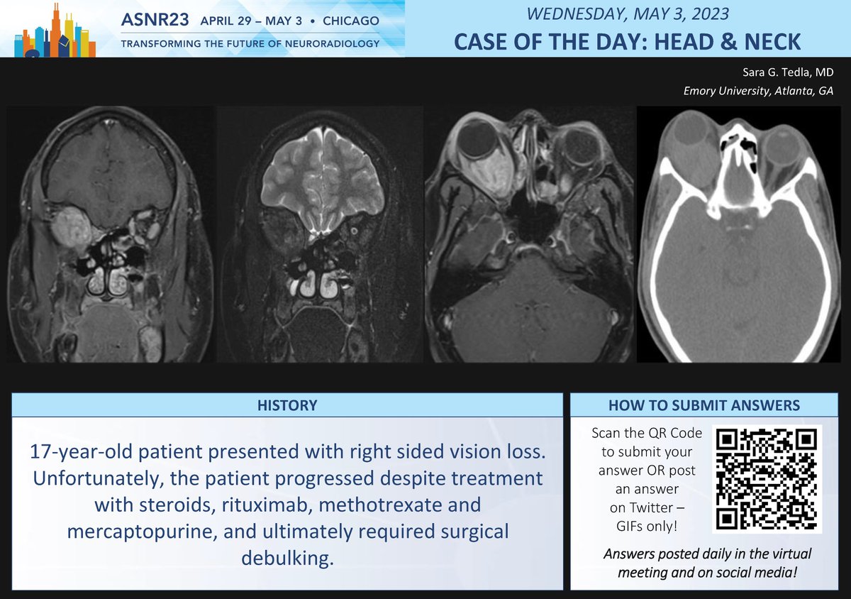 The American Society of Neuroradiology (@theasnr) on Twitter photo #ASNR23 #COTD: Head and Neck
Thx to Sara G. Tedla <a href="/SaraTedlaMD/">Sara Tedla MD</a>
NO SPOILERS!!! Give answers as GIFs ONLY.
Submit answers for a chance to win prizes! Answer tomorrow morning.
#ASNR23 #Neuroradiology #FOAMed #Medtwitter #RadRes #ASNR23 #COTD: Head and Neck
Thx to Sara G. Tedla <a href="/SaraTedlaMD/">Sara Tedla MD</a>
NO SPOILERS!!! Give answers as GIFs ONLY.
Submit answers for a chance to win prizes! Answer tomorrow morning.
#ASNR23 #Neuroradiology #FOAMed #Medtwitter #RadRes