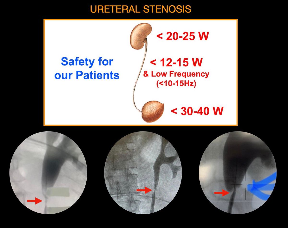BN105:Today with HighPowerLaser(HoYAG 100-150W&TFL60W)we face more&more UreteralLesion(Stenosis!) Our responsibility as KOL-Experts&LaserCompany is to RECOMMEND“SAFE SETTINGS” forPatient&not“OptimalOnes”for max.EFFICIENCY.Please pay attention toURETER.Use LowPower&LowFrequency🙏