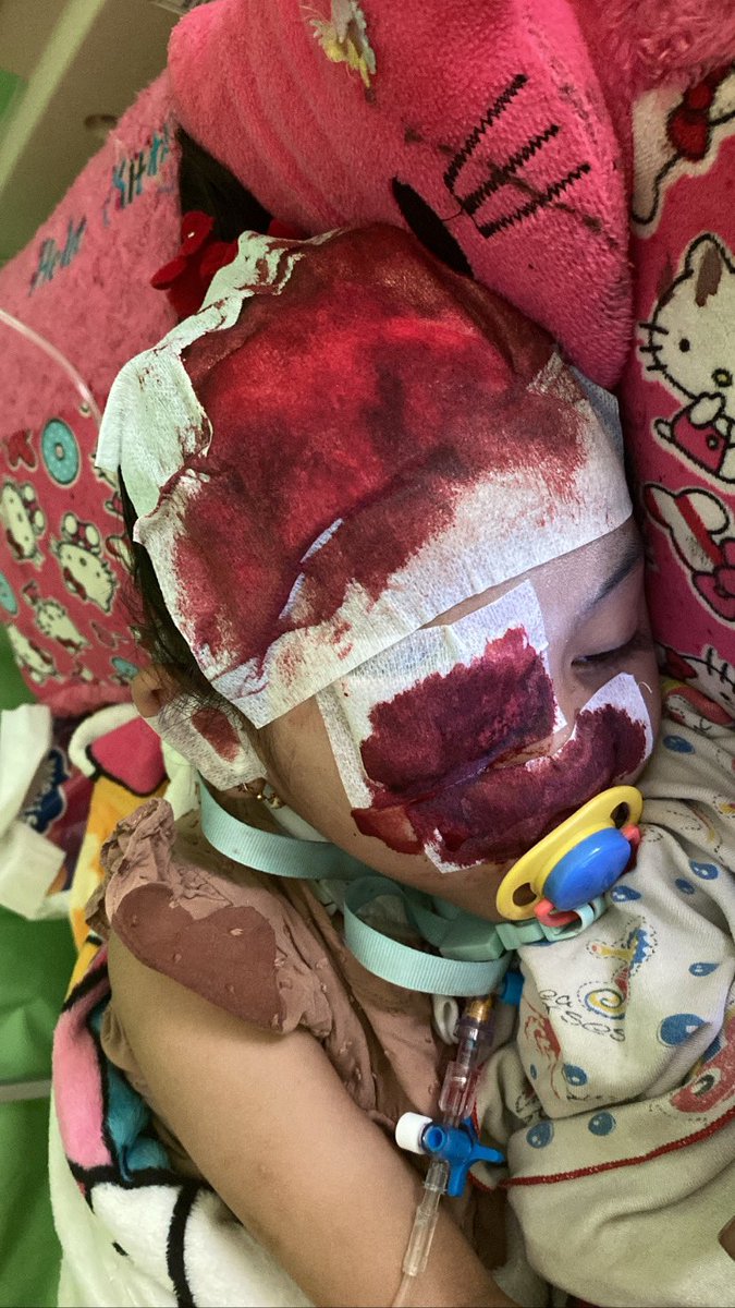 Adik kita Lula kembali berjuang dengan penyakit nya, sekarang adalah hari ke 8 nya dirawat di rs aws samarinda, sekarang tidak genap sebulan dd Lula kembali kambuh, bisa dibilang tubuhnya sudah semakin lemah…. #kelainandarahlangka #pejuangBSS #KoinPerduliLula