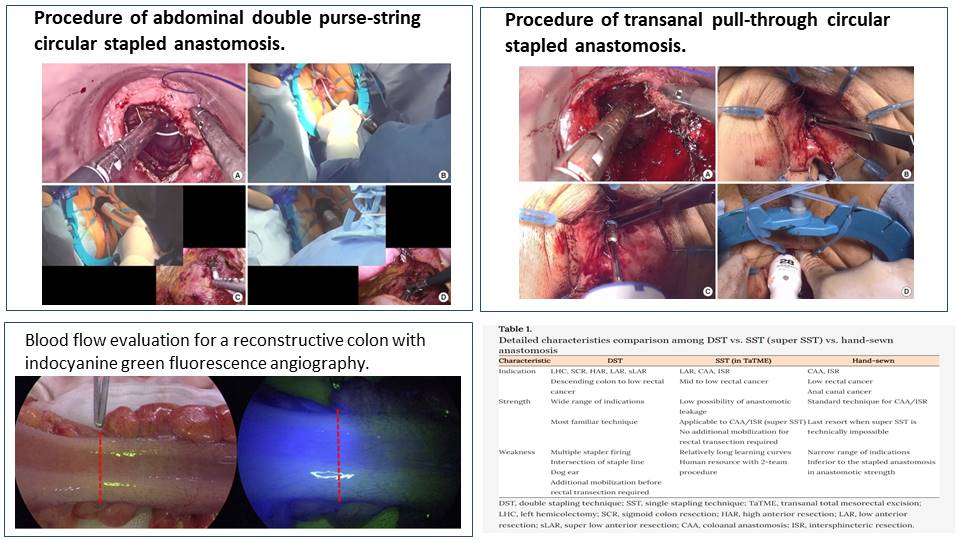 AColoproctology's tweet photo. Let's read an informative review
article by Daichi K. and Masaaki I. on the optimal
anastomotic technique in rectal surgery for preventing
anastomotic leakage.
#leakage #rectal surgery #stapling
DOI: https://t.co/ph3QKw8415 https://t.co/CcVqUMtoqm