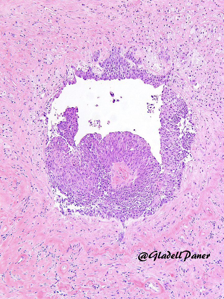 Gladell Paner, MD (@gladellpaner) on Twitter photo As we prepare for the first ever <a href="/IntSocUropath/">International Society of Urological Pathology</a> Consensus Conference on Urachal Neoplasms.
Let’s remind ourselves that this can occur…
👉Papillary urothelial carcinoma within a (supravesical) urachal remnant.
The vast majority of urachal tumors are glandular (adenocarcinoma). As we prepare for the first ever <a href="/IntSocUropath/">International Society of Urological Pathology</a> Consensus Conference on Urachal Neoplasms.
Let’s remind ourselves that this can occur…
👉Papillary urothelial carcinoma within a (supravesical) urachal remnant.
The vast majority of urachal tumors are glandular (adenocarcinoma).