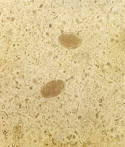 Hookworm eggs seen on an iodine wet mount.

#Fortheloveofmicrobiology #clinicalmicrobiology #mmidsp #microrounds #IDpath #ASMClinMicro
#MicroTwitter #WomenInSTEM #WomeninMicrobiology #STEM #medtwitter #ClinMicro #microbiologypakistan #PathBugs