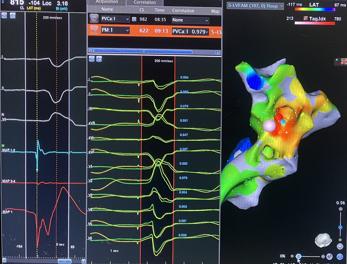 This has to be the biggest compliment I received for an ablation; my patient is into modern art, he framed the 3D map of his PM pap PVC ablation I performed yesterday! Map by @Jason__Mumford