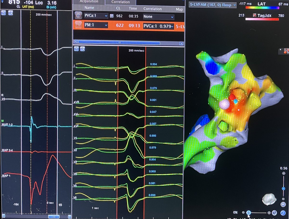 Auroa Badin (@badinmd) on Twitter photo This has to be the biggest compliment I received for an ablation; my patient is into modern art, he framed the 3D map of his PM pap PVC ablation I performed yesterday! Map by <a href="/Jason__Mumford/">Jason Mumford</a> This has to be the biggest compliment I received for an ablation; my patient is into modern art, he framed the 3D map of his PM pap PVC ablation I performed yesterday! Map by <a href="/Jason__Mumford/">Jason Mumford</a>