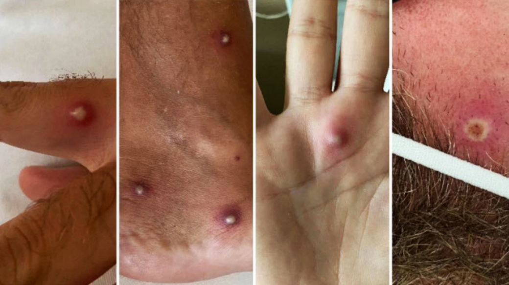 México enfrenta brote mortal de Mpox con 26 defunciones confirmadas dlvr.it/SnT4x7