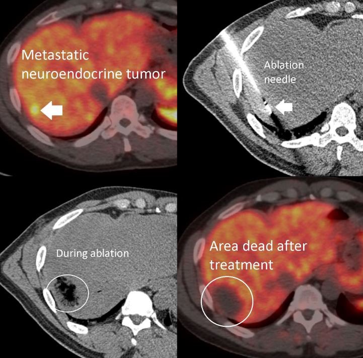 Small area of metastatic #neuroendocrine tumor in the liver that was burned to death via a thin needle placed by interventional radiology (#IRad) under CT guidance during an outpatient procedure. Follow up DOTATATE PET shows an excellent response to treatment.