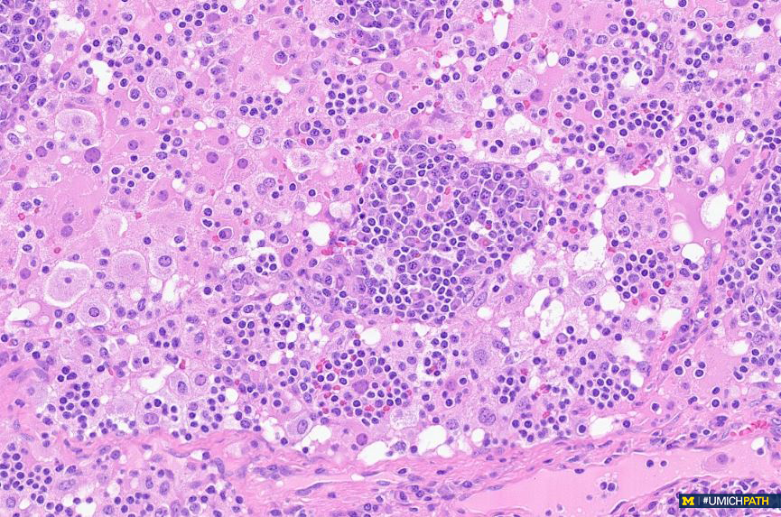 New #COTW from @IsabellaDishong!

A 62-year-old female with cervical lymphadenopathy. What is your ddx? What stains would be helpful?