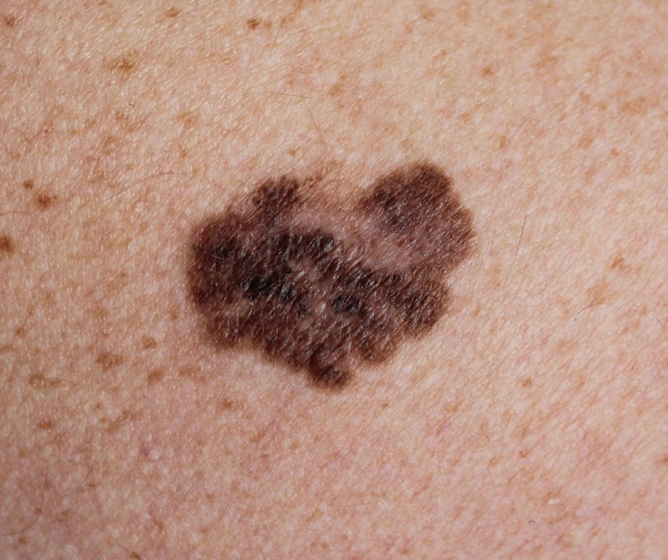 wehapodiatry's tweet photo. Notice a strange growth or discoloration on your foot? Don’t ignore it! Skin cancer often goes unnoticed on our feet. Call our office today to schedule a checkup! https://t.co/GHtwEpx7uN https://t.co/K6vig17iP6