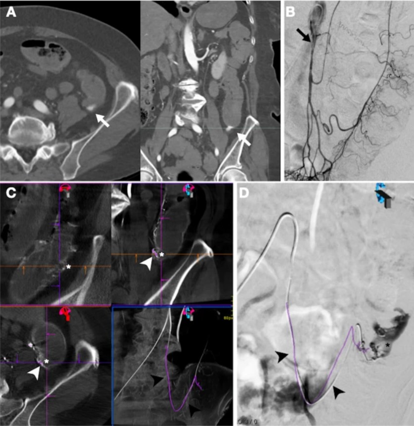 Here, the authors present 2 methods to perform a prompt empiric #TAE in #LGIB when catheter #angiography is negative

What can this do for procedure time? How was the culprit bleeding artery targeted?

Read the full paper for free below:
cvirendovasc.springeropen.com/articles/10.11… #IRad