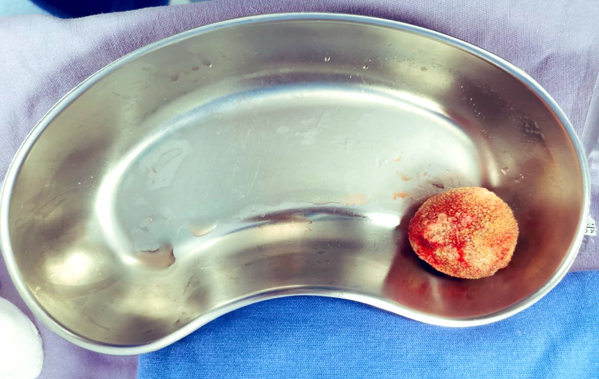 In public hospitals w/0 to min. resources Open cystolithotomy is still the best (if not the only) choice

A good soldier successfully fights with available weapons whichever they are cit by Napoleon

<a href="/EIvanBravoC/">Edgar Iván Bravo 🇲🇽😬🤘🏻</a> <a href="/comargg/">Dr. Carlos Omar German Garrido</a> <a href="/theurologist1/">Dr. Marcos Del Rosario Santiago</a> <a href="/niteshkuro/">Nitesh Kumar</a> <a href="/UrologyTimes/">Urology Times</a> @GoumasUrologia