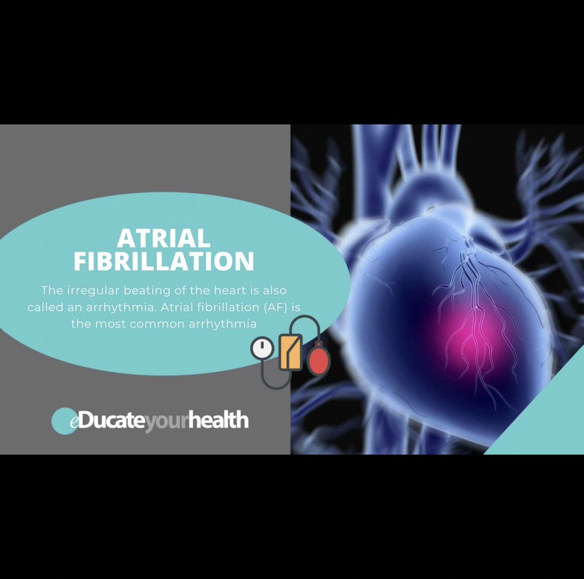 The most common complaint of AF is palpitations, an uncomfortable, rapid and irregular heartbeat, which usually makes patients anxious. To learn more about it go to our website:

educateyourhealth.com/patients/atria…

#educate #stayhealthy #staysafe #atrialfibrillation