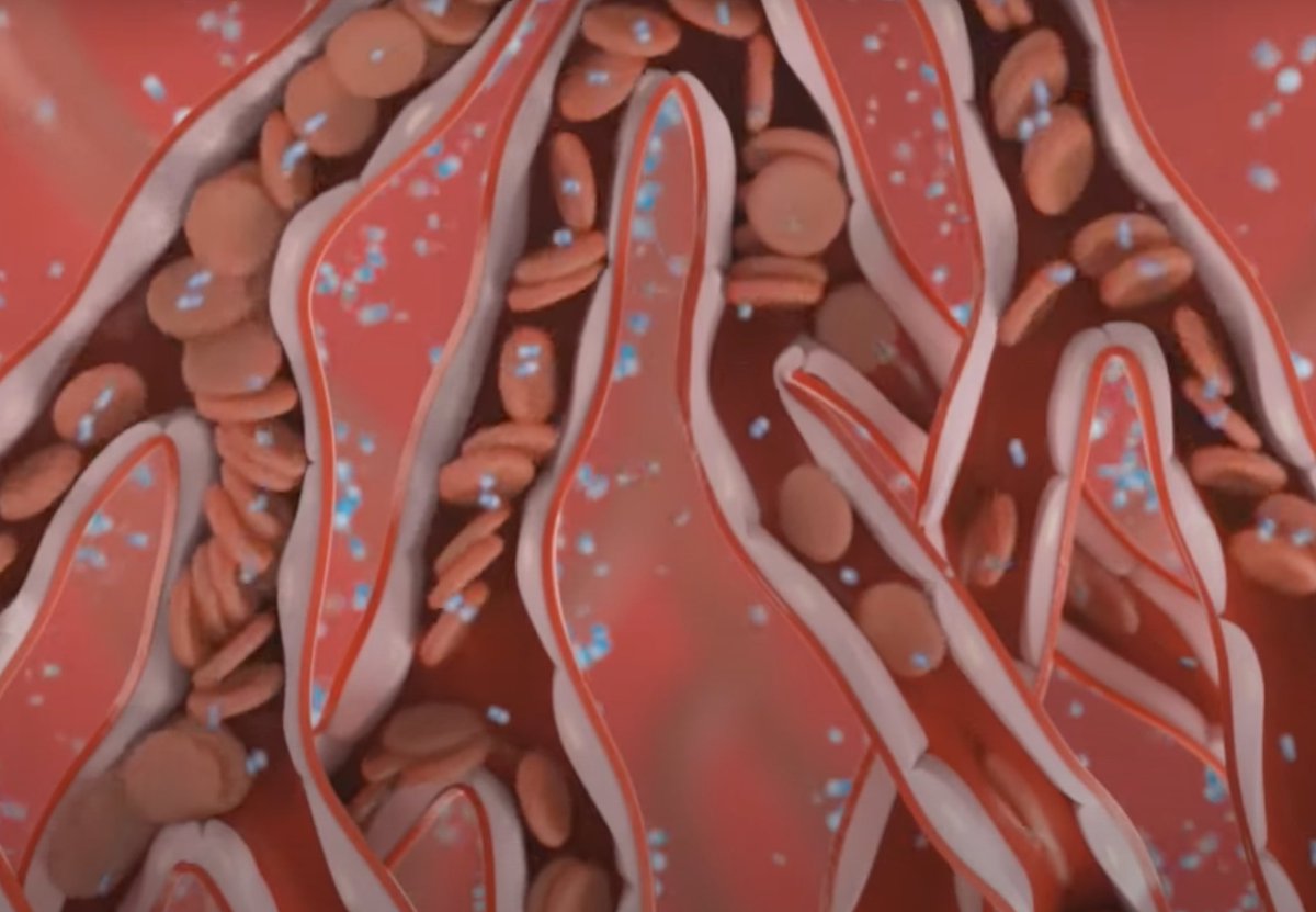 ZOLLTherOx's tweet photo. #SSO2 works to address microvascular obstruction in #STEMI by increasing oxygen diffusion in the ischemic capillary bed to reverse endothelial edema. Learn more here: https://t.co/adL1FLpSZV #Survive2Thrive #ThinkTherOx https://t.co/SHM3xPjU4I