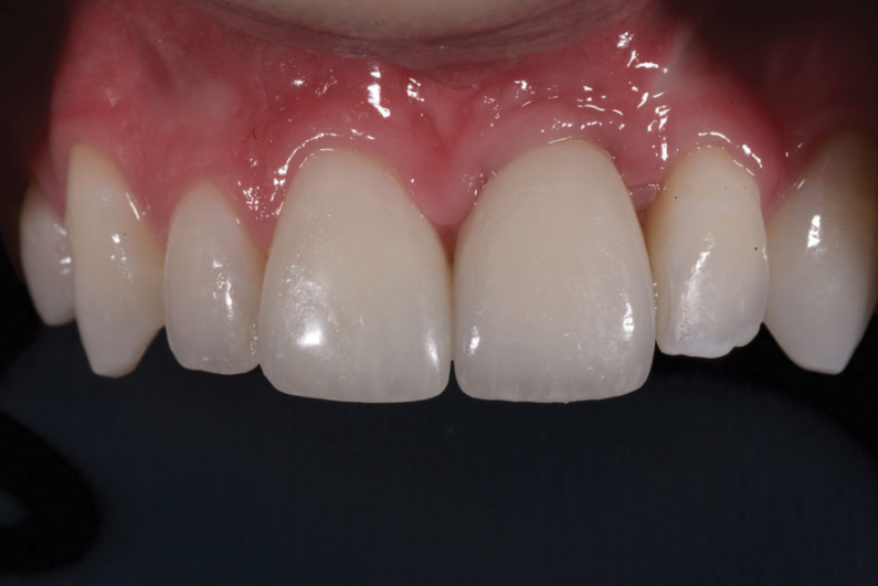 InDentalTech's tweet photo. In case you missed it! #MasterClassFlashback: “Interdisciplinary Treatment in an Esthetically Challenging Case” by Sergio Rubinstein, DDS; Barry P. Levin, DMD; Elizabeth R. Michalczyk, DMD, PhD; Yan Razdolsky, DDS; and Toshiyuki Fujiki, RDT https://t.co/5wPtblC2sd https://t.co/J9dYvJ45J9