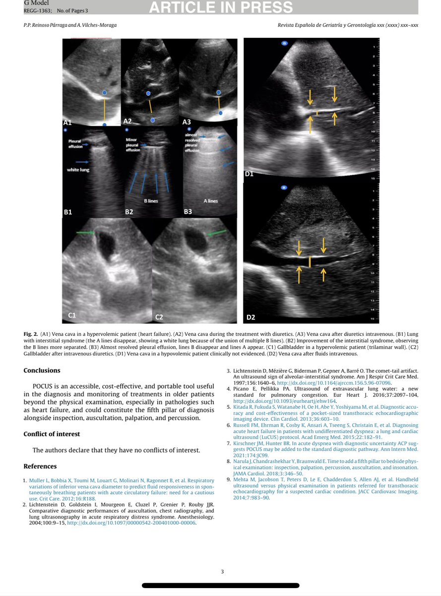 Is Point of Care Ultrasound Useful for the evaluation of blood volume and alveolar-interstitial syndrome in older patients? Serie of Cases 
<a href="/GeriatriaLaPaz/">Geriatría Hospital U. La Paz</a> <a href="/EuGMSSociety/">EuGMS - European Geriatric Medicine Society</a> <a href="/GeriSoc/">British Geriatrics Society</a> <a href="/GeriaCruzRoja/">Geriatria Hospital Cruz Roja</a> <a href="/Wally_Gator_MD/">Juan I González Montalvo</a> <a href="/nmonterof/">Nuria Montero</a> <a href="/oncogeri/">Javier Martinez Peromingo</a> <a href="/GeriatriaGuada/">Geriatría Guadalajara</a> <a href="/hupuertahierro/">Geriatría HUPuertaHierro</a>