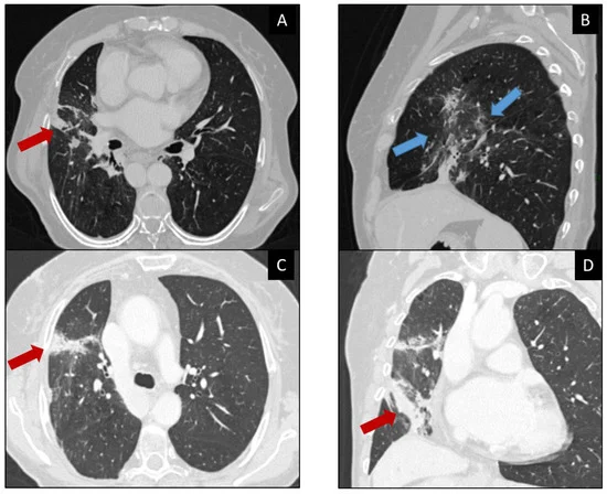 Interesting article on #radiological signs and differential diagnosis according to the organ affected by adverse effects of #immunotherapy.
@RadioONCO @oncologician @oncotwitts 
mdpi.com/1718-7729/30/5…