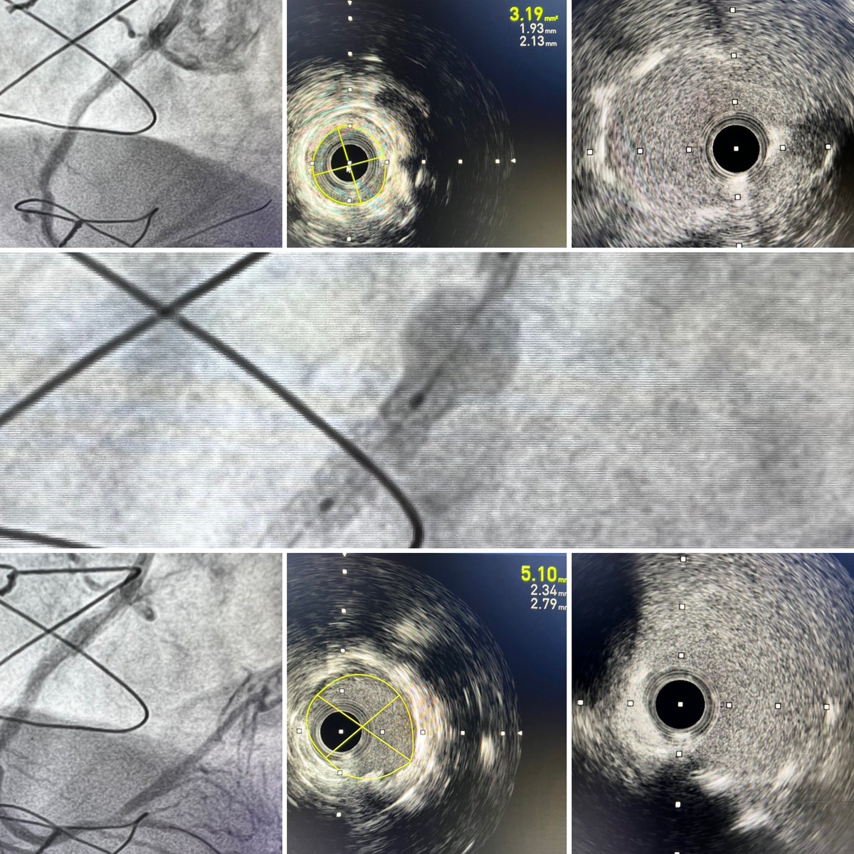 Lorenzo Azzalini (@lazzalinimd) on Twitter photo Recalcitrant 2-layer ostial RCA #ISR with overhanging struts in the aorta. Scoreflex @csi360, Shockwave <a href="/ShockwaveIVL/">Shockwave Medical</a>, Ostial Flash @OstialFLASH, and brachytherapy. +59% increase in MSA.
Advanced tools for complex problems that require effective solutions. 💪🏼 <a href="/KovachMd/">Christopher Kovach</a> Recalcitrant 2-layer ostial RCA #ISR with overhanging struts in the aorta. Scoreflex @csi360, Shockwave <a href="/ShockwaveIVL/">Shockwave Medical</a>, Ostial Flash @OstialFLASH, and brachytherapy. +59% increase in MSA.
Advanced tools for complex problems that require effective solutions. 💪🏼 <a href="/KovachMd/">Christopher Kovach</a>