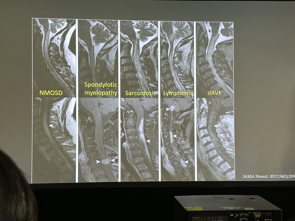 Dr. Carlos Torres makes differentiating demyelinating diseases of the spine a little bit easier for #neurorads.  #ASNR23