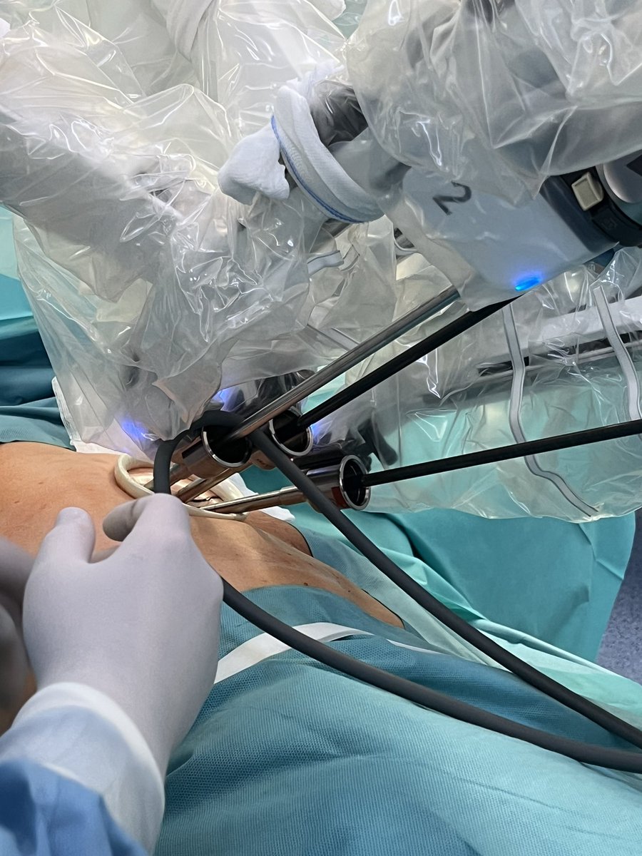 ThorSurgHClinic's tweet photo. Robotic surgical day with different thoracic approaches: multiport #RATS left lower lobectomy and uniportal RATS #uRATS S1 right segmentectomy https://t.co/LxiZkDap2G