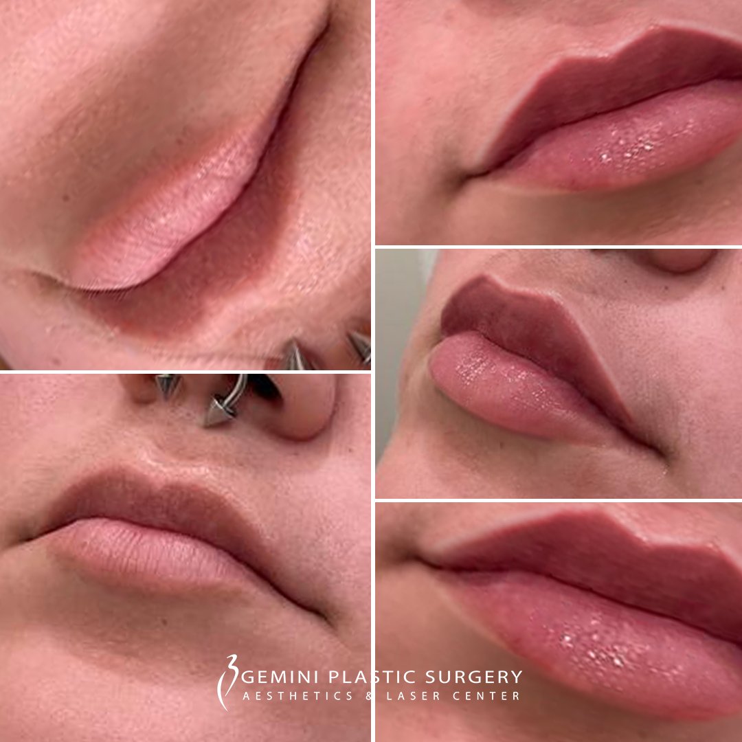 Lip Fillers #010-019
Get those lips 👄 ready for kisses! 

Book Christina, RN!

geminiplasticsurgery.com

#medispa #medspa #lipfillers #lips #lipinjections #botox #fillers #dermalfillers #aesthetics #juvederm #beauty #geminiplasticsurgery #lipaugmentation #lipenhancement