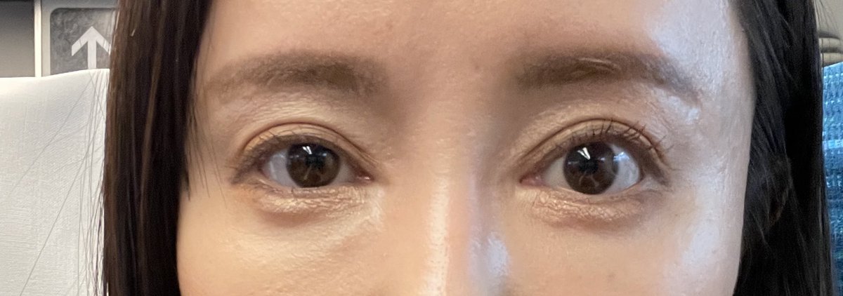 weekendumeko's tweet image. やあ😀大阪帰省なう

うめこは今週土曜、右目の埋没をして眼瞼下垂を治します。

ノーマルカメラで自撮りしてみるとやっぱ気になる🤔凹み目もなんとかならんかなー脂肪注入？したらええんかなーどう思う？

それよりGW明けに普通に出社して大丈夫かしら🤔ダウンタイムI日しかない…😭