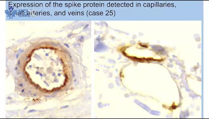 FairfieldView's tweet photo. Spike protein lining the interior of blood vessels. 

Dr Hoffe absolutely demolishing the narrative. 

“We literally have the pandemic of the vaccinated”

@Inquiry_Canada https://t.co/wcocp5gG8U