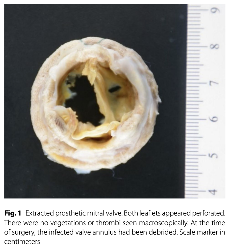 @KahnMauricio superb report of patient @UAB_ID w/ prosthetic valve #endocarditis from Tropheryma whip-lei @UABCVI @UABCardiology #IDTwitter rdcu.be/dbiCm