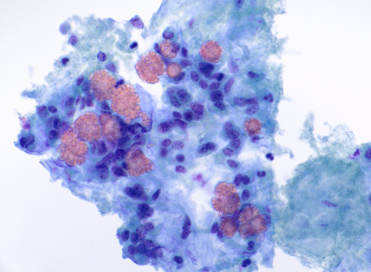 HubertLauMD's tweet image. Beautiful tyrosine crystals in a pleomorphic adenoma (ThinPrep) #CytoPath #FNApath #ENTpath

Photo credit: @PathologyBadBoy