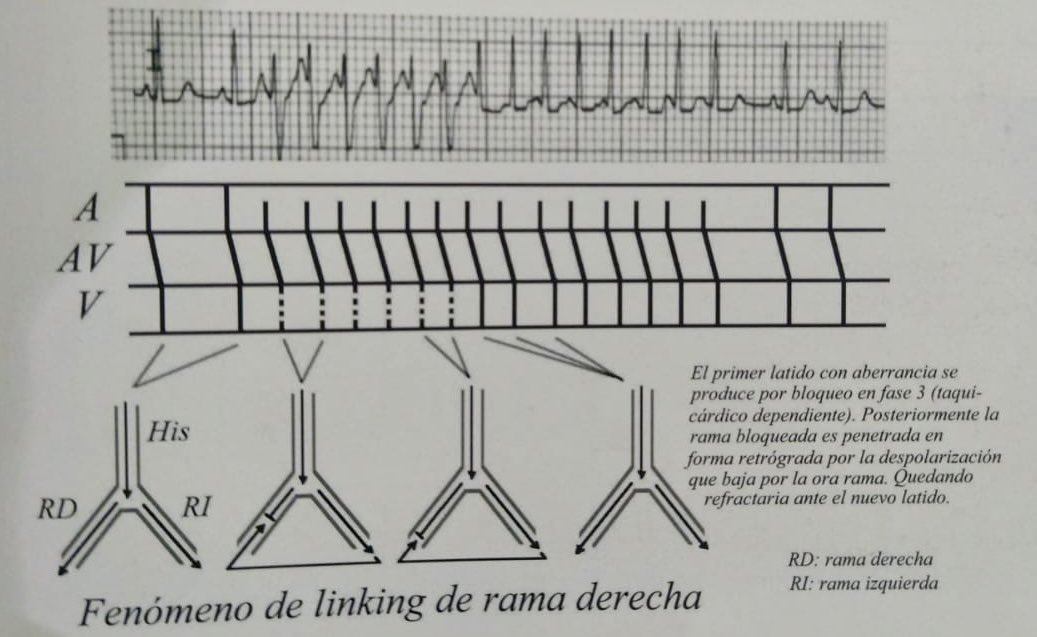 SerRgioB's tweet photo. @UlhasDr Fenómeno de Linking de rama derecha, taquicardia auricular. https://t.co/aYUhjTUL37