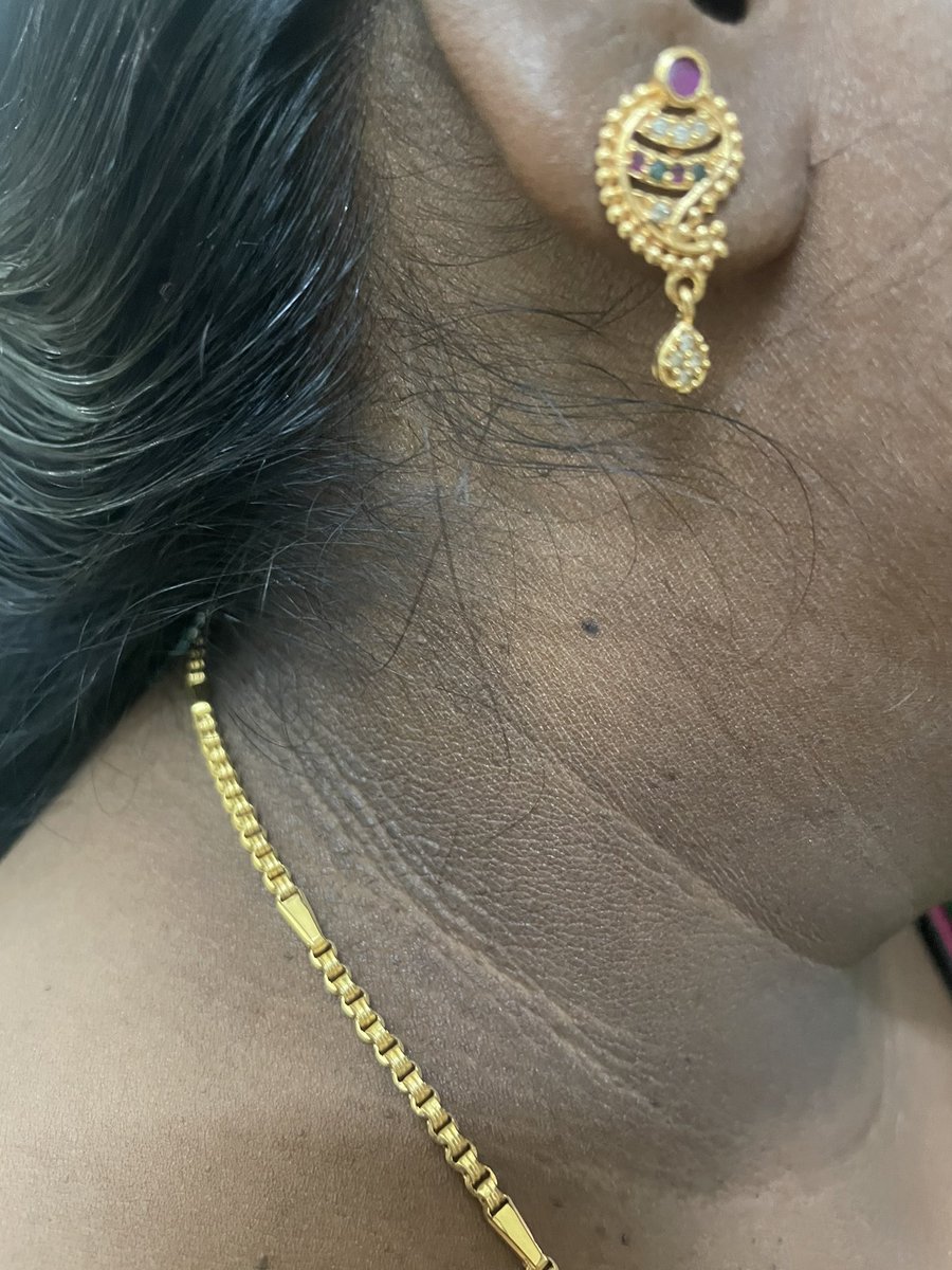 idrlakshmi's tweet photo. This patient came with cosmetic concerns and was diagnosed with diabetes. This dark velvety patch that usually appears in the armpits, neck or groin is known as Acanthosis nigricans and could be a harbinger for underlying diabetes and metabolic disorders. Get yourself tested! https://t.co/ZyYp3YQ2FZ