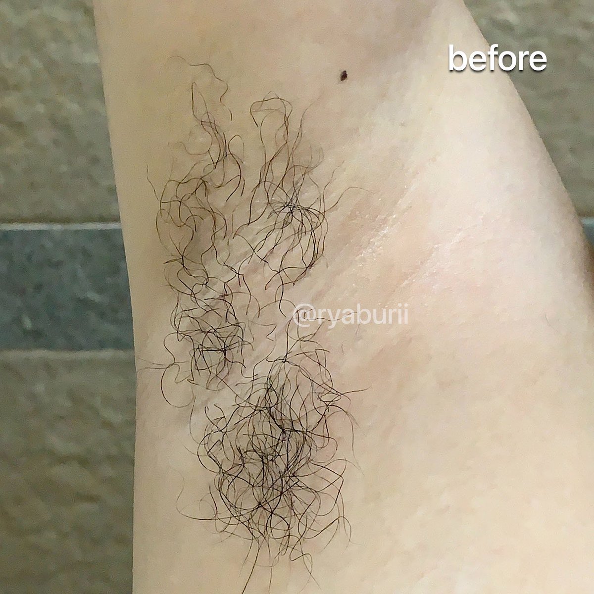 ryaburii's tweet photo. AKHIRNYA membabat habis semua bulu underarmku yang udah gondrong karena udah ga waxing dari taun 2022 wkwkw.

siapa disini yang mau waxing tp msh gatau caranya? ATAU msh maju mundur? hr ini aku review full yah including rasanya kayak apa dan perlu apa aja! #racuninskincare https://t.co/Uu43aRRTij