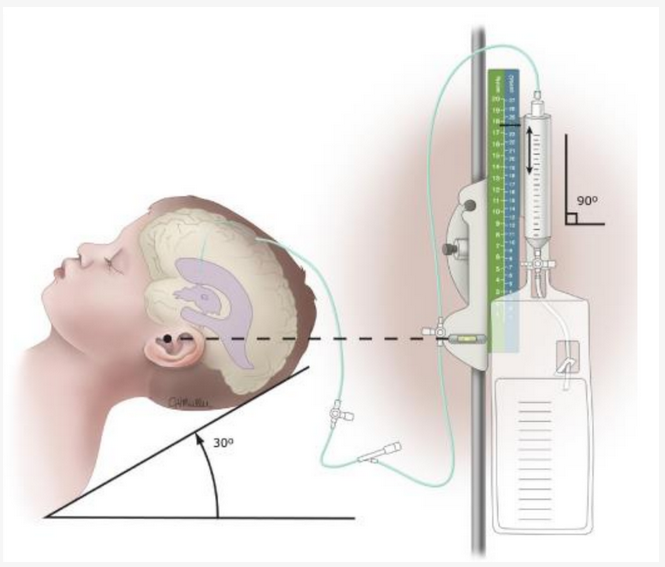 CritCareReviews's tweet photo. Today's Paper of the Day is by @Alessan65903420 on external ventricular drainage: a practical guide for neuro-anesthesiologists https://t.co/A4LQM8XnFE