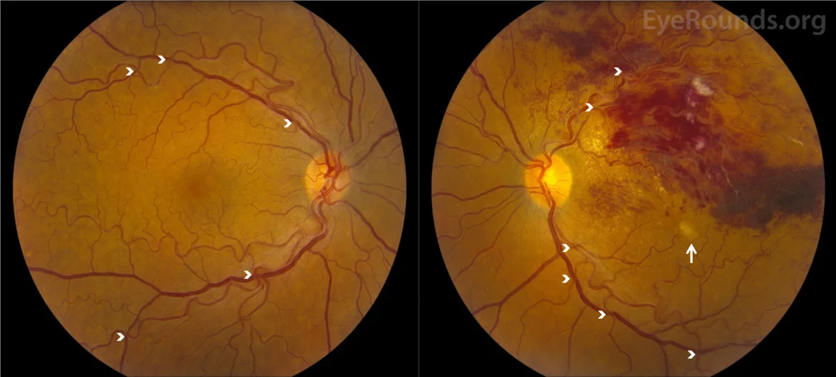 Normal (left) vs. Vascular occlusion (right)