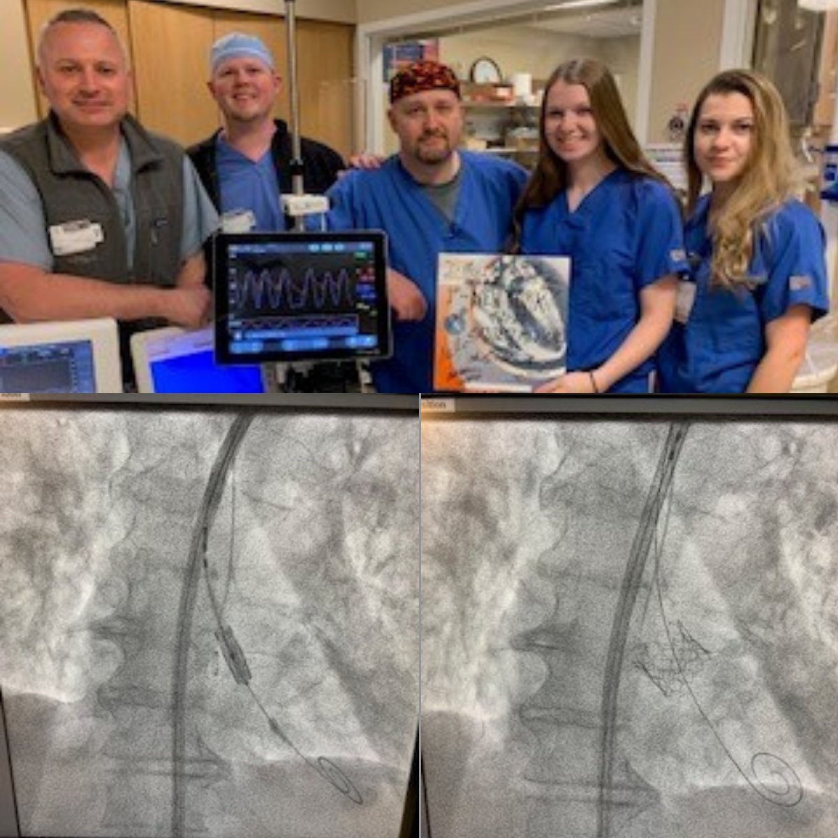 HAEQuebec's tweet photo. #SavvySpotlight: 42mmHG pre-gradient, #LVpacing with #SavvyWire to implant 23mm valve! Post-gradient measurement of <1mmHG! Congratulations to Dr. Menzies and the Bassett Medical Center Structural Heart team! #SavvyTAVI https://t.co/UFPkeKLA6K