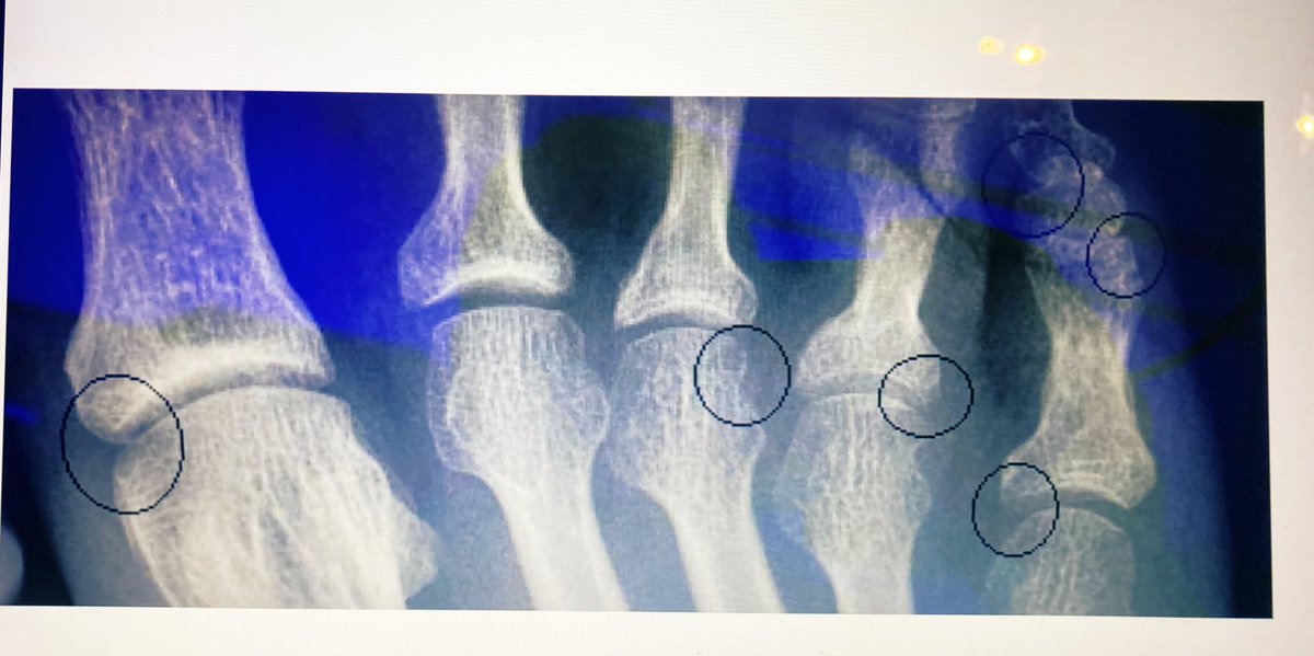 WilsonBautistaM's tweet photo. Tener nuevas alternativas de #tratamiento en enfermedades #inflamatorias constituye una necesidad y una oportunidad para los #pacientes con #artritis #psoriasis #estudiosclinicos https://t.co/G8c3CWO7D4