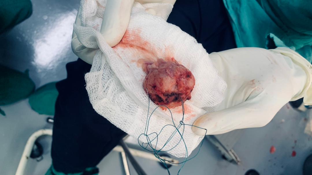 Cirugía compleja de base de cráneo unión craneoespinal, Tumor benigno Meningioma de agujero magno. 
 Servicios Neurocirugía. <a href="/DPSHabana/">Dirección General de Salud La Habana</a> @