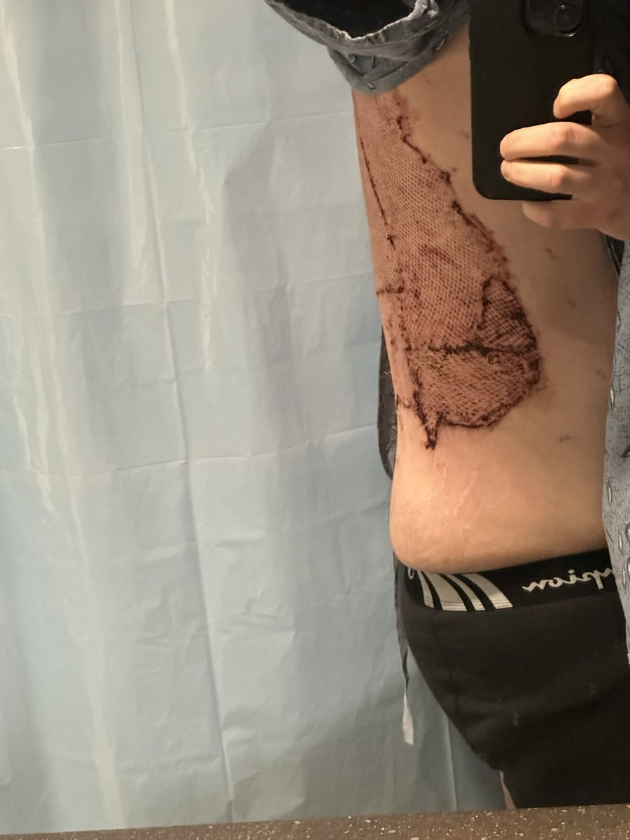 Dbor32's tweet photo. Personal note and I don’t like to do this often but it’s a milestone for me.
Almost one month ago to this day I had a horrific accident at work.
Caught on fire, suffered high 2nd to 3rd degree burns.
Had questions about where my life would go from there.. 
But today..
tweet cont* https://t.co/cgadFl4e7x