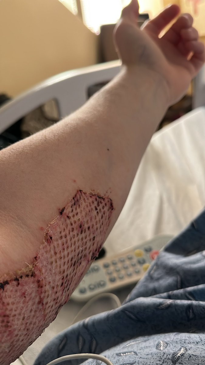 Dbor32's tweet photo. Personal note and I don’t like to do this often but it’s a milestone for me.
Almost one month ago to this day I had a horrific accident at work.
Caught on fire, suffered high 2nd to 3rd degree burns.
Had questions about where my life would go from there.. 
But today..
tweet cont* https://t.co/cgadFl4e7x