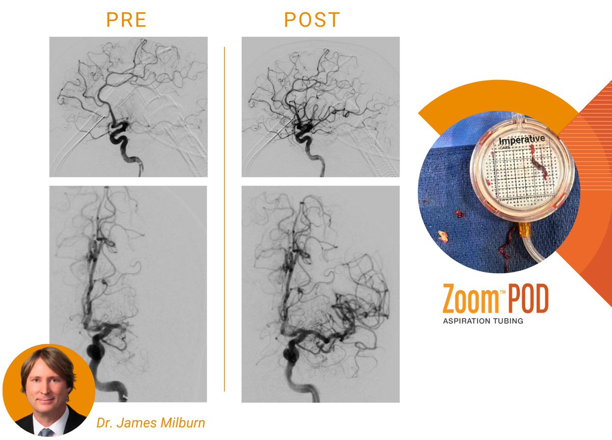 ImpCare_Stroke's tweet photo. This #ClotOfTheWeek comes to you from @docroc99 at @OchsnerHealth. In this #stroke case, Dr. Milburn used #Zoom71 + #Zoom35, resulting in a #TICI3 outcome and clot caught in #ZoomPOD. Thanks for sharing.
Rx only. ISI: https://t.co/9GLPGxG0gZ https://t.co/njt8GoI1iR