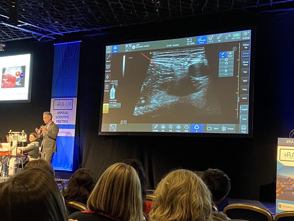 BucksUSGRA's tweet image. Femoral nerve and adductor canal blocks with @athmathottungal and @jeffgadsden 

Brilliant to hear from experts but also to learn how #DukeRAP residents manage pain out-of-hours #RAUK23