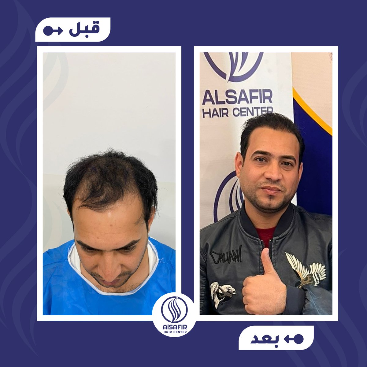 alsafirhc's tweet photo. أحد عملائنا الأعزاء قبل وبعد عملية زراعة الشعر في مركزنا 👏🏼

ما رأيكم بالنتيجة؟

مركز السفير يوفر لك الخيار الأمثل لاستعادة شعرك الطبيعي 💯
أحجز الآن ولا تتردد لتحصل على أفضل النتائج

تواصل معنا عبر:
📱+90 530 673 07 39
واتسآب: https://t.co/Y1f29lMl1H https://t.co/kOodyKw3ZI