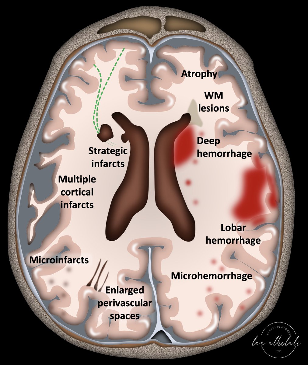 Just because it's called SMALL vessel disease doesn't mean it doesn't have a BIG impact! Small vessel dz is a BIG contributor to vascular dementia along w/large vessel cortical infarcts Do you know all the faces of small vessel dz? #medtwitter #neurotwitter #stroke #MedEd