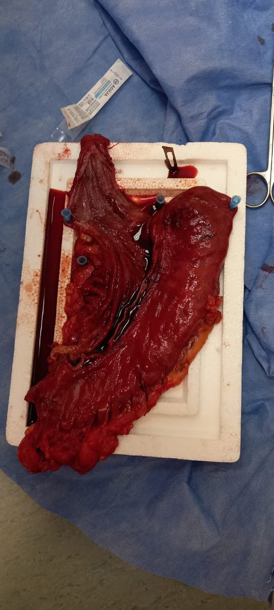 sofia_gambetta's tweet photo. Just sharing some cool pics from an infrequent procedure, the 2nd in our hospital: Distal-continual colon interposition for esophageal reconstruction after esophagectomy. #surgerycases #radres #FOAMrad #surgicaleducation https://t.co/dYqdVm5kPF