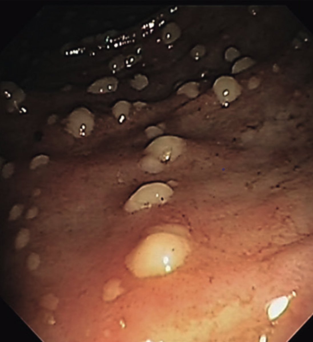 drkeithsiau's tweet image. Appearance of the sigmoid colon in a patient with recurrent cellulitis and diarrhoea. What’s the diagnosis?