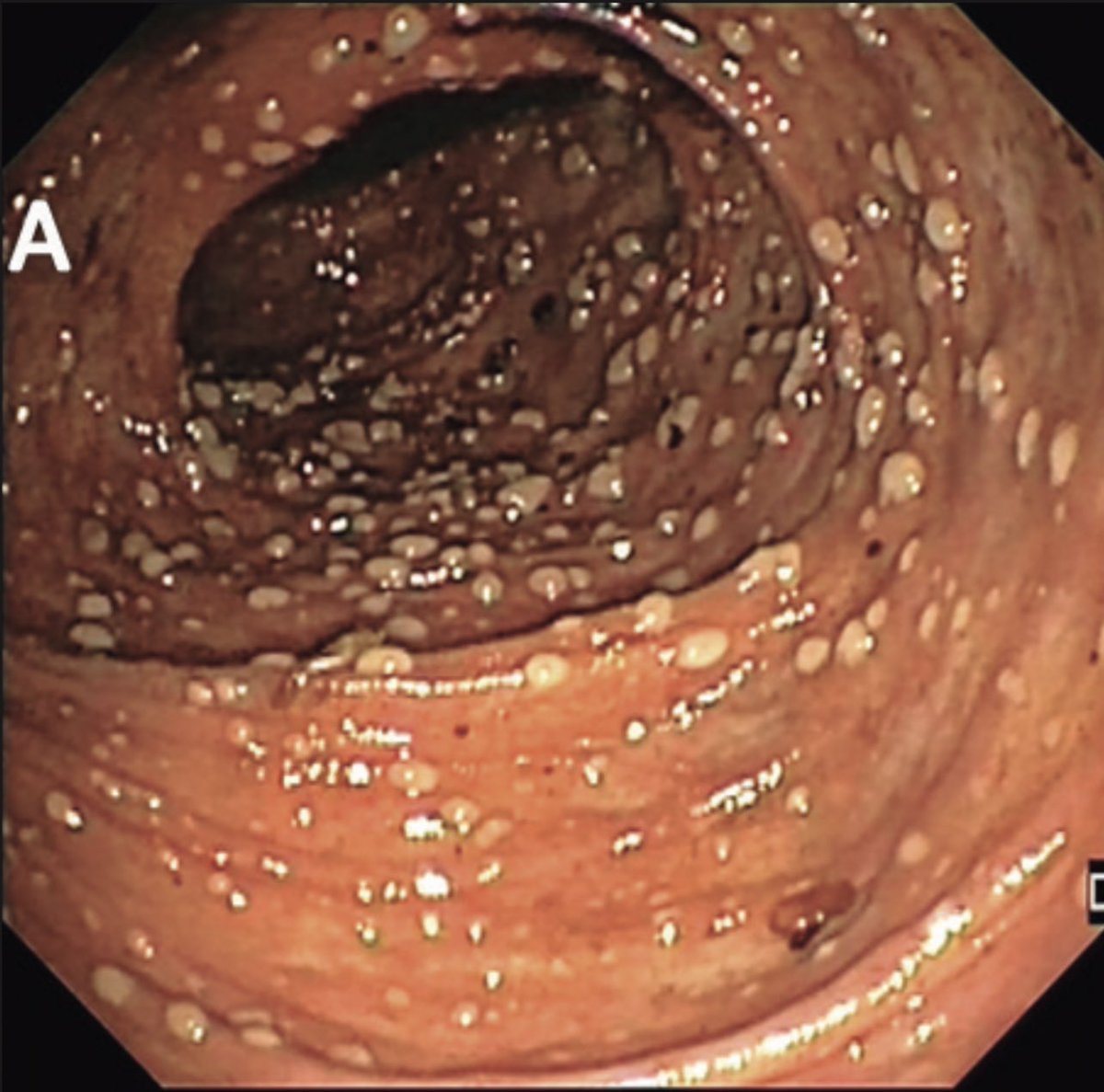 drkeithsiau's tweet image. Appearance of the sigmoid colon in a patient with recurrent cellulitis and diarrhoea. What’s the diagnosis?