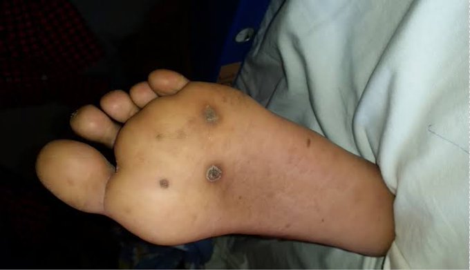 the_beardedsina's tweet photo. Young Man rushed to hospital, he cannot open his mouth, his body is stiff and hard. 

Last week he stepped on a nail, &amp; they were using hot oil on the wound. Sadly he died  

What happened?
could the death have been prevented? https://t.co/k4SSUUCU2D